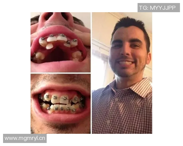 亚马尔自信分享戴牙套体验称其外观与自我形象完美契合